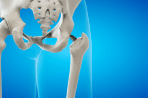 Walking Speed as a Key to Better Hip Arthroplasty Outcomes: Evidence from PASS and K-Means Analysis