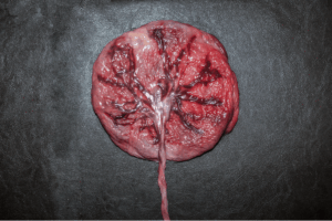 Extracellular Matrix Disorganization as a Central Feature of Placenta Accreta Spectrum