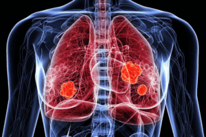 Highly Plastic Cancer Cells Identified as a Key Engine of Lung Tumor Progression